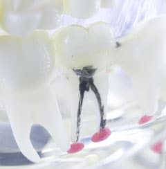Root Canal Treatment In Mansfield At Advanced Dentistry & Dental Implant Center