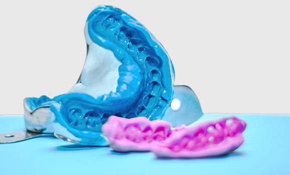 Teeth Impressions For Dental Bridges In Mansfield, OH