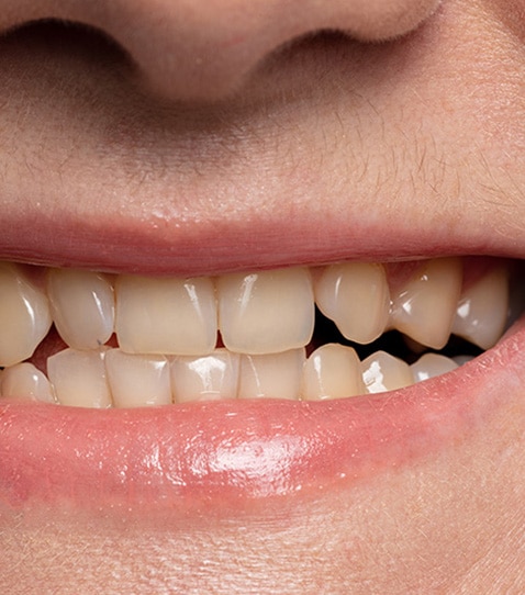 close-up-smile-with-yellow-teeth-before-whitening You Might Need Teeth Whitening If You Have Uneven Coloration