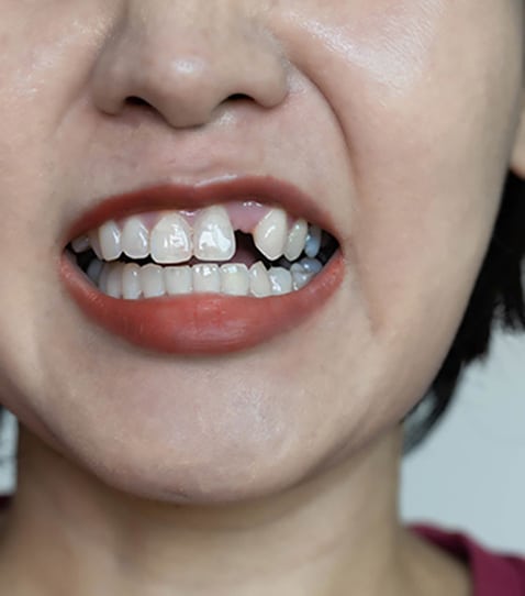 girl-s-teeth-missing-teeth-bad-dental-health You Might Need Teeth Whitening If You Have Yellowing Or Staining Of Teeth