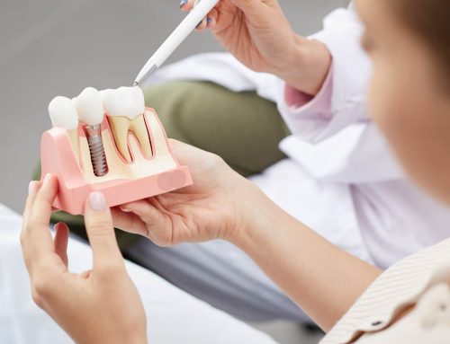 Dental Implants Vs. Bridges: Which Is Better For You?